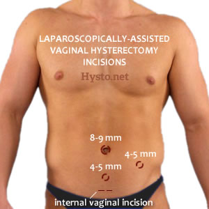 Laparoscopic Hysterectomy incisions